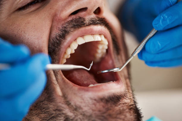 Best Knocked-Out Tooth (Avulsed Tooth) Treatment in , OR